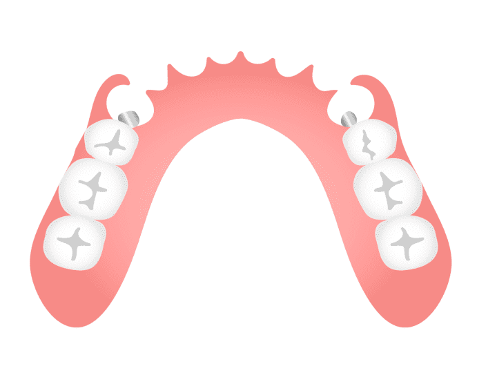 ノンクラスプデンチャー