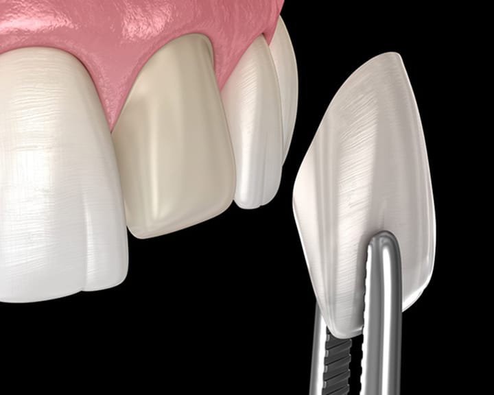 ラミネートベニア