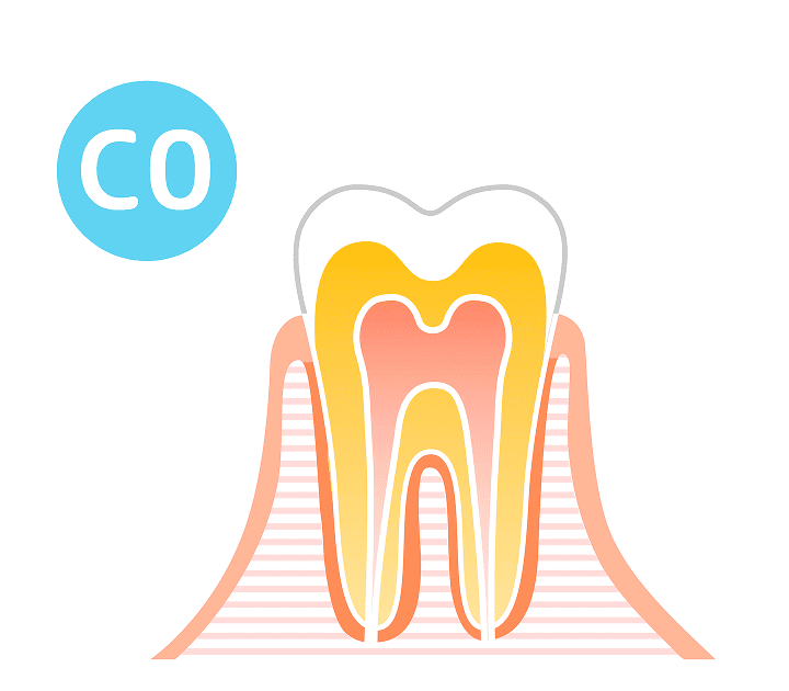 CO(初期の虫歯/脱灰)