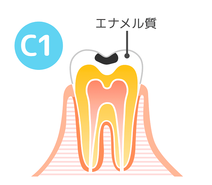 C1(エナメル質の虫歯)