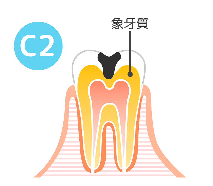 C2(象牙質の虫歯)