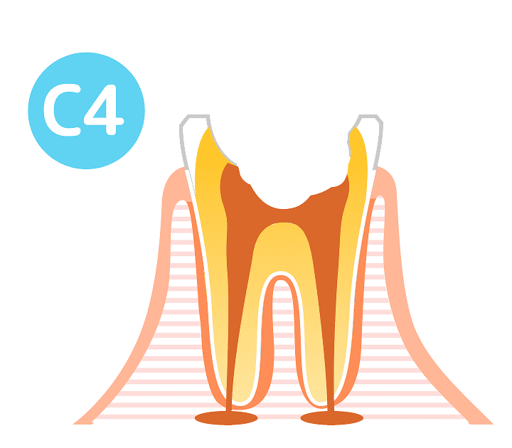 C4(歯根に達した虫歯)