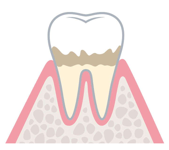 軽度歯周病