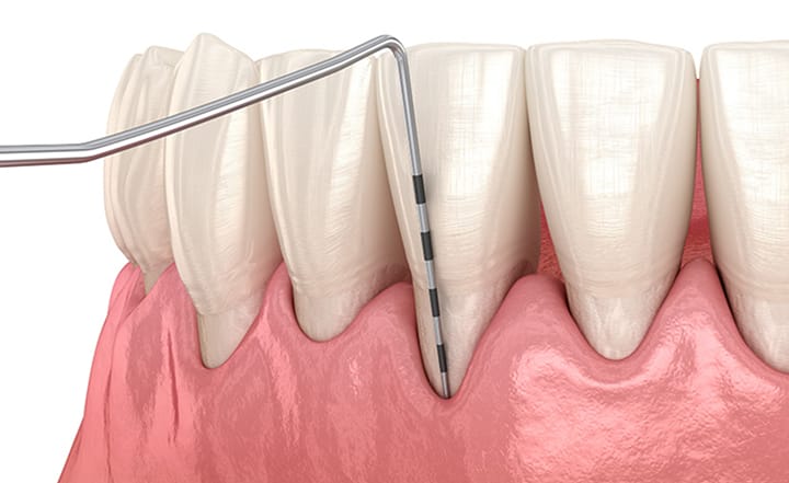 歯周ポケット検査