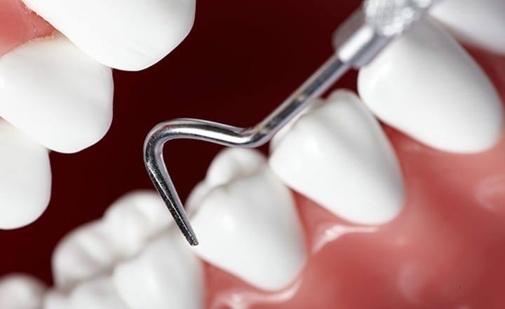 歯の動揺度検査