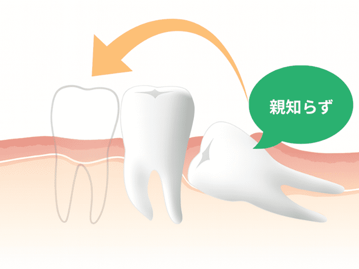 歯牙移植について